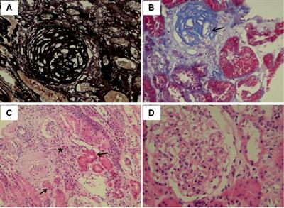 A novel CLCN5 frame shift mutation responsible for Dent disease 1: Case report